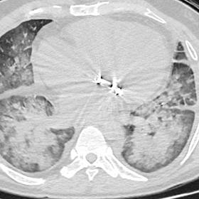 Non-contrast CT scan of thorax axial (B) and coronal (A) images in lung window showing bilateral dependent consolidation and 