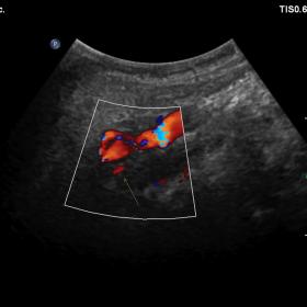 Color Doppler sonography of the left ICA showed two vessels of different calibre (exam performed with the convex probe becaus