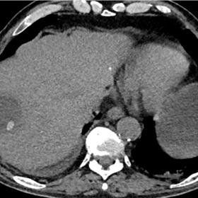 Axial unenhanced CT image shows a perihepatic fluid collection with a 10-millimetre radiodense stone within it