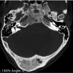 CT images, axial section in bone window. Demonstrates mixed areas of sclerotic and ground-glass appearance with an expansive 