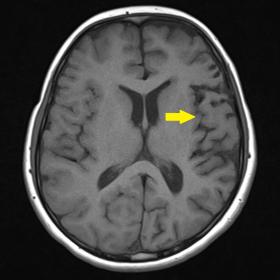 T1 axial section showing left hemicerebral atrophy
