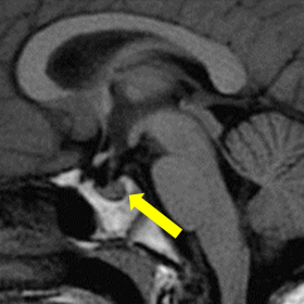 MRI T1 Sagittal (Pre-contrast): Note the loss of T1 posterior pituitary bright
