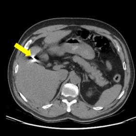 CT (plain) – axial - Gallbladder is not visualized – Post cholecystectomy status with metallic clips in the gallbladder f