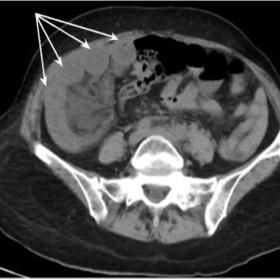 Axial non-contrast and contrast enhanced (venous phase) CT show radial array of dilated fluid-filled edematous ileal loops (m