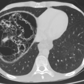Axial contrast enhancement abdominal CT using the pulmonary window demonstrates multiple air-filled cysts on the wall of the 