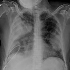 Plain chest radiograph frontal view showing diffuse homogenous radiodense opacifications involving predominantly peripheral r