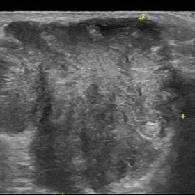 Ultrasound examination of the right axilla revealed a hypoechoic solid mass, well-demarcated, with irregular shape