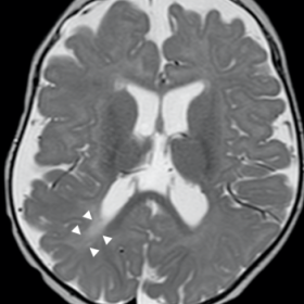 Axial T2 shows hyperintensity of the periventricular white matter (white arrowheads) and diffuse cerebral atrophy