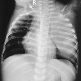 Frontal chest radiograph shows a well-defined large homogenous soft tissue opacity in the left lung field sparing a part of t