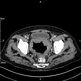 A large soft tissue mass with a central gas filled cavity is visible anterior to the rectum