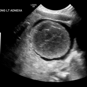 Long grayscale ultrasound of the left adnexa demonstrates a well-circumscribed heterogeneous lesion measuring up to 3.3 cm in