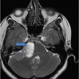 T2 axial MRI shows well-defined extra-axial T2 heterogenous hyperintense lesion at right CP angle (blue arrow) with mild mass