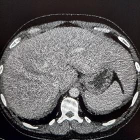 Selected axial portovenous phase CT image showing subtle non-enhancing hypodense focal liver lesions