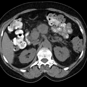 Axial CT without intravenous contrast showing two pancreatic lesions isodense to the parenchyma, with a central hypodense are