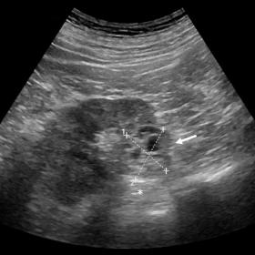Oblique axial ultrasound image (B-mode) of the right kidney reveals a heterogeneous renal mass (arrow) with posterior acousti