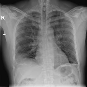 Chest x-ray, posteroanterior view, at the time of the symptoms: There is a wedge-shaped pleural-based opacity in the right lo