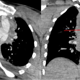 Contrast-enhanced chest CT, arterial phase. Axial-obliqued (left) and coronal (right) images evidence the irregular outpouchi
