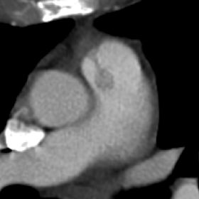 Thoracic CT scan (axial plane) shows a well defined pediculated mass on the pulmonary valve