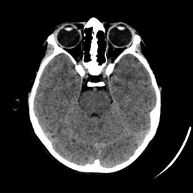 Axial CT brain image shows no intraparenchymal brain abnormalities. Both globes, extraocular muscles, optic nerves and retrob
