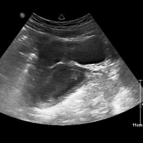 US: Enlarged uterus  close to an ipoechogenic pelvic mass