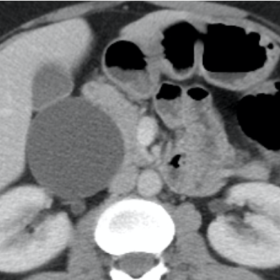 Contrast-enhanced CT scan in the axial (a) and coronal (b, c) planes. The images showed a well-defined, thin-walled and bilob