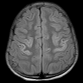 FLAIR axial image showing hyperintense signal in the perirolandic cortex