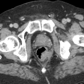 Initial axial contrast-enhanced CT in the portal-venous phase: CT scan shows an irregular thickening of the left low posterol