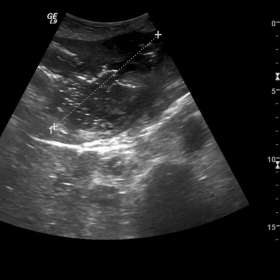 Grayscale ultrasound image obtained in the transverse plane, through the left lobe of the liver, shows a sizeable heterogeneo