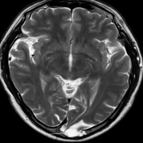 Axial T2 weighted MRI image showing herniation of high signal intensity left occipital lobe through the defect in inner table