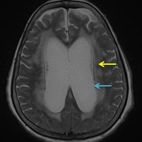 Axial T2 weighted image at the level of the lateral ventricles shows dilatation of B/L lateral ventricles with periventricula