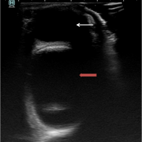 A double layered anechoic cyst (red arrow) is seen posterior to and indenting the eyeball (white arrow) on B scan ultrasound 
