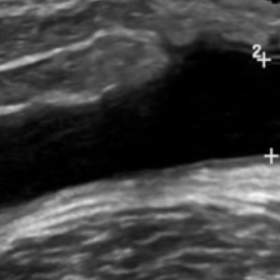 Ultrasound shows relatively well-defined anechoic collection between the subcutaneous fat and deep fascial plane of knee