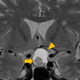 Coronal T2W image showing a well-defined (arrowhead) cystic lesion with both sellar and suprasellar components and an intra-c