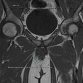 A defect within the tunica albuginea of the right-sided corpus cavernosum close to the base of the penis - Coronal T1W