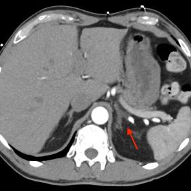 Infarction of the left adrenal gland. CT angiography of the aorta when arriving on the first day at the emergency room showed
