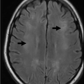 Axial FLAIR image at the level of centrum semiovale showing symmetrical hyperintensity (arrows) in subcortical, deep and peri