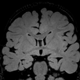 Coronal FLAIR weighted image showing hippocampus inversion