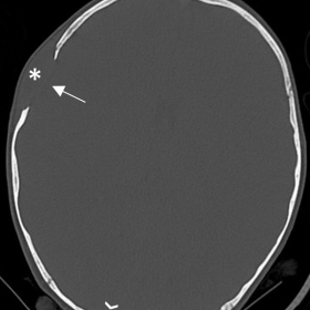 Axial CT image of the skull in bone window (A). Note an osteolytic parietal lesion (white arrow) with ‘bevelled edges’ and adjacent subgaleal soft tissue swelling (asterisk). A smaller lesion with irregular borders is present occipital (arrow point). On 3D reformat (B), a double contour due to uneven destruction of the inner and outer table is noted (arrow)