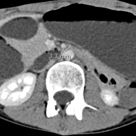 CT scan in the venous phase showing the axial plane performed at admission highlights the decreased aorto-mesenteric distance