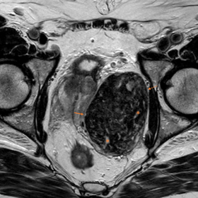 Multiparametric MRI of the prostate. Axial (a and d), coronal (b) and sagittal (c) T2-weighted images (T2WI), and axial T1-we