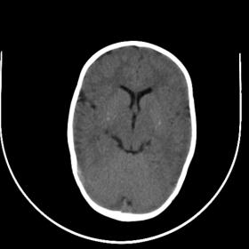 Linear hyperdensities in bilateral basal ganglia. Hypodense areas in the head of caudate nucleus on the left side and the len