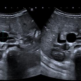 Ultrasound (a) transverse and (b) longitudinal images. Fusiform dilatation of intra and extrahepatic segments of common bile 