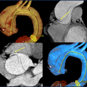 CT scan revealed an intimal flap originating from the area of the right coronary artery