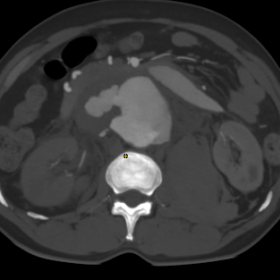 Aneurysmal dilation of aorta with right lateral wall defect and lobulated contrast filled pouch projecting into the retroperitoneal hematoma