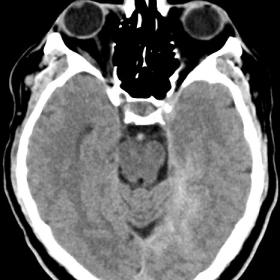 Noncontrast axial CT shows hyperdense intra-axial lesion
