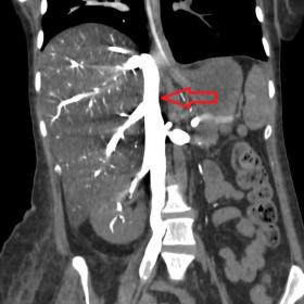 Contrast-enhanced CT scan coronal reformat in: A) contrast in inferior vena cava (red arrow); B) contrast in superior vena cava (red arrow) and right atrium (green arrow)