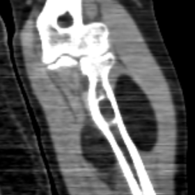 Computed tomography- Coronal images show a well-defined hypodense lesion with a sclerotic rim in the proximal end of the radi