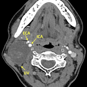 Axial CECT shows a large low-density CS mass with the anteromedial displacement of the carotid vessels and posterior displace