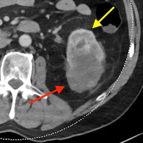 69-year-old male known with metastatic RCC and in second-line treatment with Axitinib. The patient came to the emergency depa