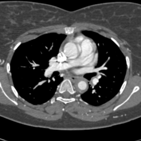 Axial section of Contrast-enhanced CT chest shows diffuse circumferential wall thickening of the thoracic aorta